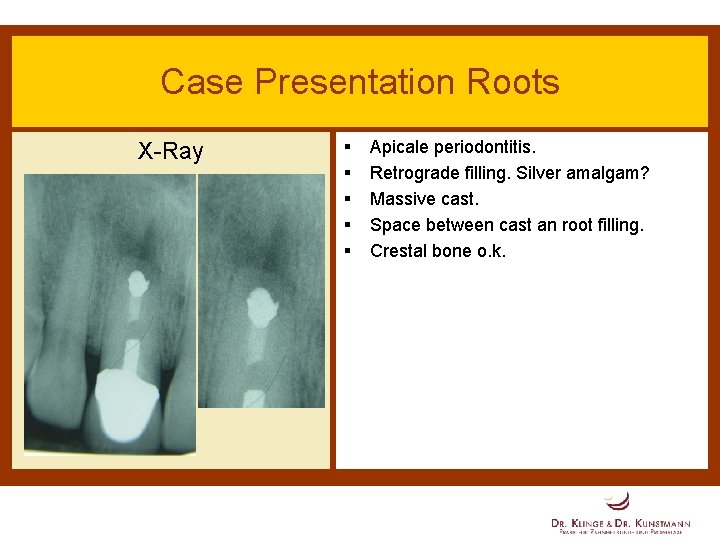 Case Presentation Roots X-Ray § § § Apicale periodontitis. Retrograde filling. Silver amalgam? Massive