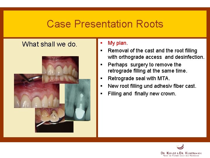 Case Presentation Roots What shall we do. § § § My plan. Removal of
