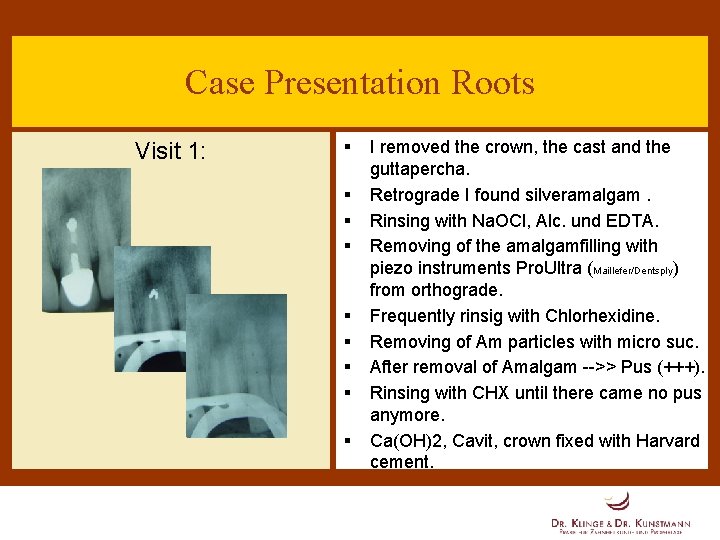 Case Presentation Roots Visit 1: § § § § § I removed the crown,