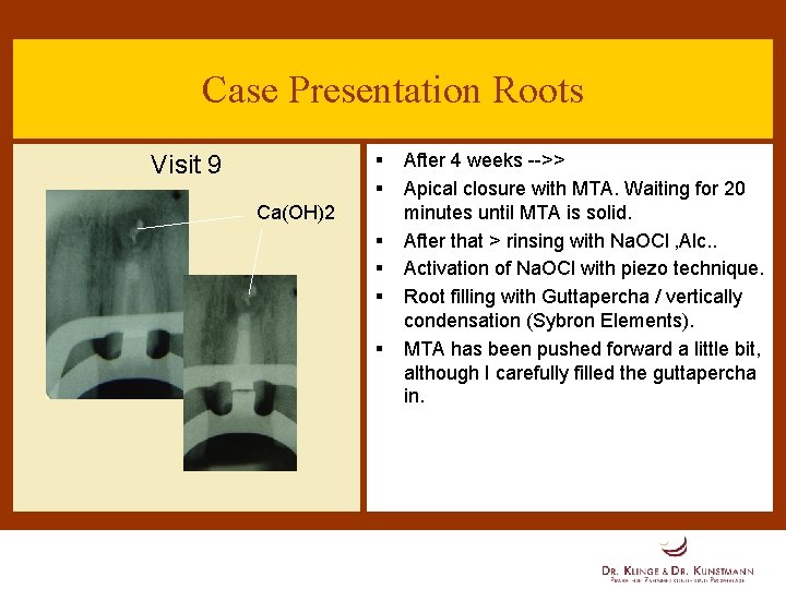 Case Presentation Roots § § Visit 9 Ca(OH)2 § § After 4 weeks -->>