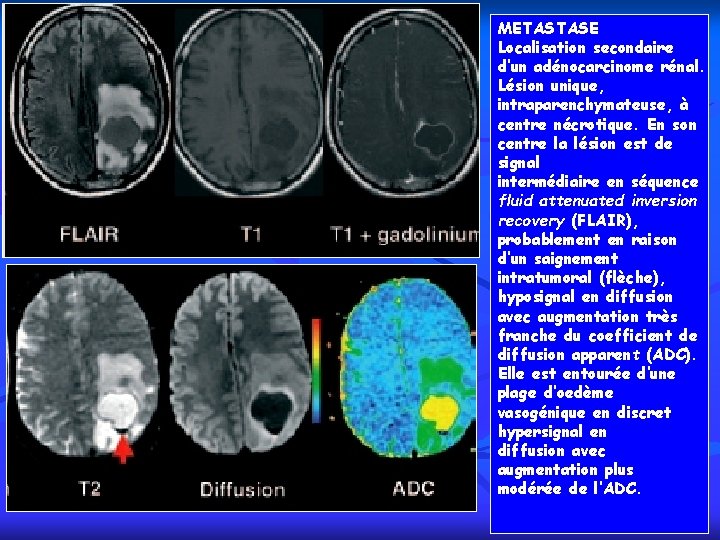 METASTASE Localisation secondaire d’un adénocarcinome rénal. Lésion unique, intraparenchymateuse, à centre nécrotique. En son