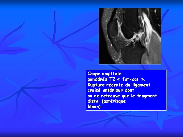 Coupe sagittale pondérée T 2 « fat-sat » . Rupture récente du ligament croisé