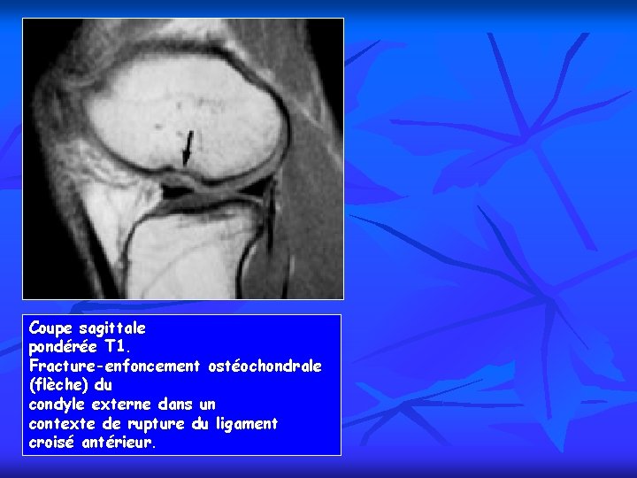 Coupe sagittale pondérée T 1. Fracture-enfoncement ostéochondrale (flèche) du condyle externe dans un contexte