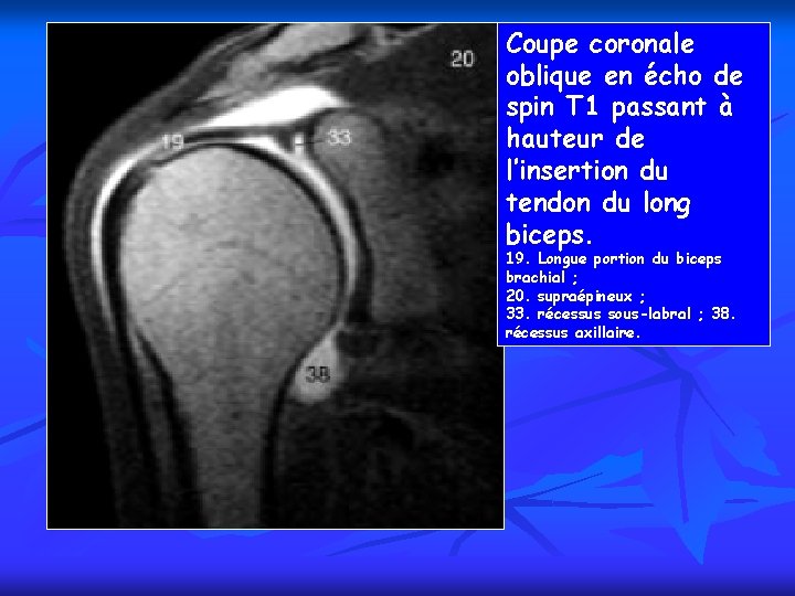 Coupe coronale oblique en écho de spin T 1 passant à hauteur de l’insertion