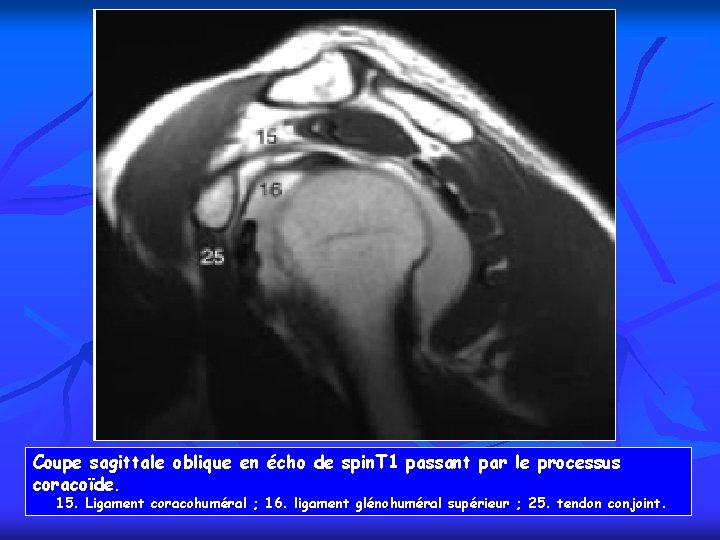 Coupe sagittale oblique en écho de spin. T 1 passant par le processus coracoïde.