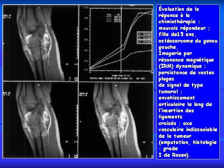 Évaluation de la réponse à la chimiothérapie : mauvais répondeur ; fille de 15