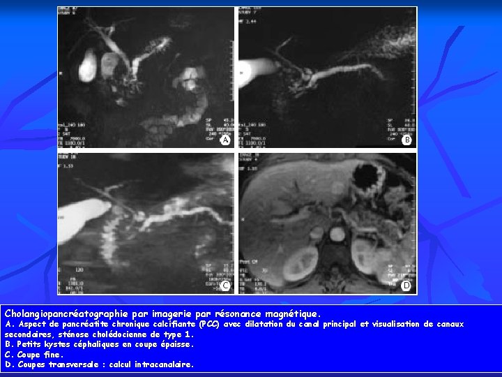 Cholangiopancréatographie par imagerie par résonance magnétique. A. Aspect de pancréatite chronique calcifiante (PCC) avec