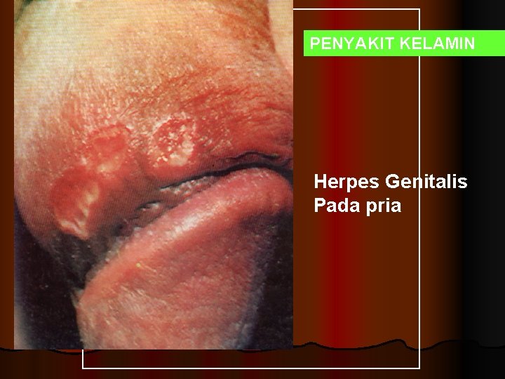PENYAKIT KELAMIN Herpes Genitalis Pada pria 