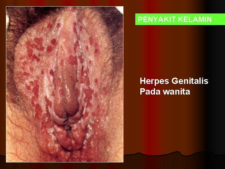 PENYAKIT KELAMIN Herpes Genitalis Pada wanita 