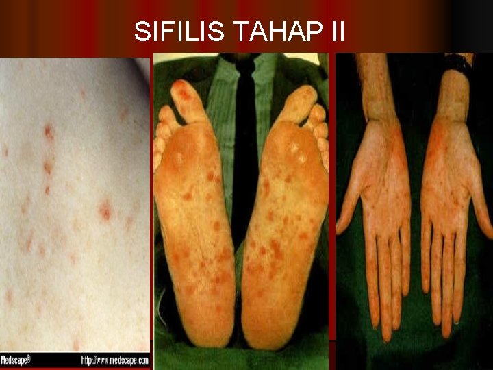 SIFILIS TAHAP II 