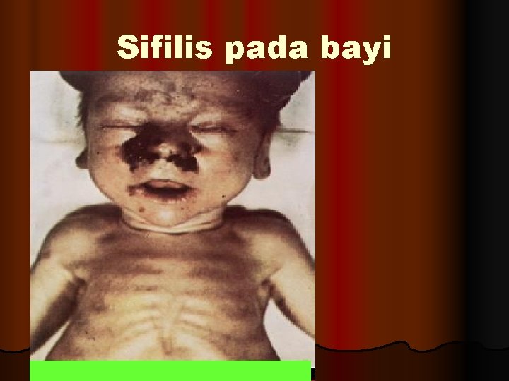 Sifilis pada bayi 