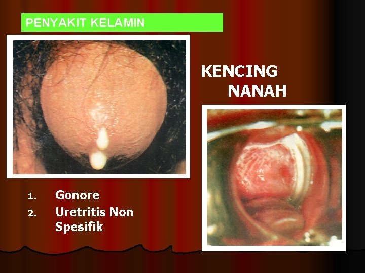 PENYAKIT KELAMIN KENCING NANAH Gonore 2. Uretritis Non Spesifik 1. 