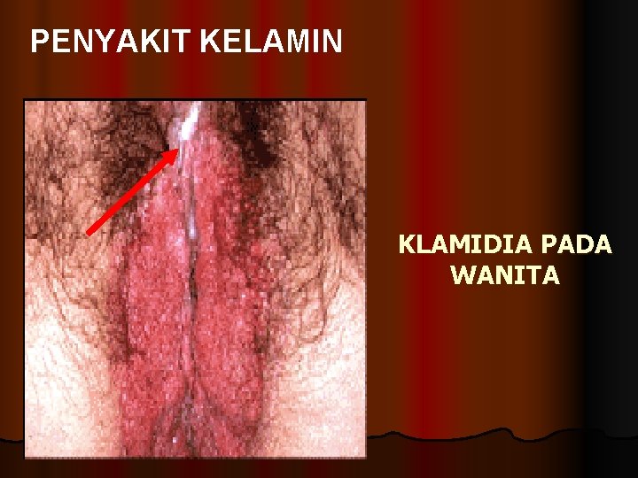 PENYAKIT KELAMIN KLAMIDIA PADA WANITA 