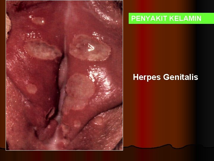 PENYAKIT KELAMIN Herpes Genitalis 