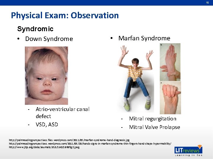 10 Physical Exam: Observation Syndromic • Down Syndrome - Atrio-ventricular canal defect VSD, ASD