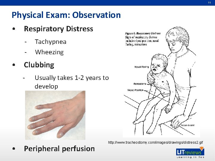 11 Physical Exam: Observation • Respiratory Distress - Tachypnea Wheezing • Clubbing - Usually