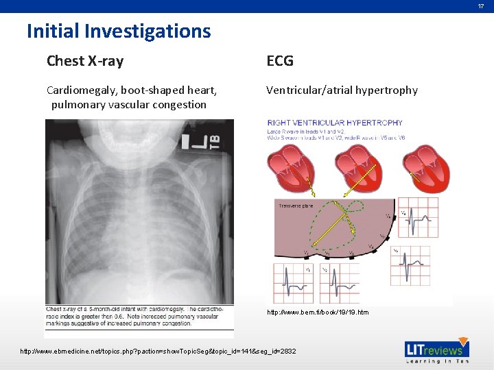 17 Initial Investigations Chest X-ray ECG Cardiomegaly, boot-shaped heart, pulmonary vascular congestion Ventricular/atrial hypertrophy