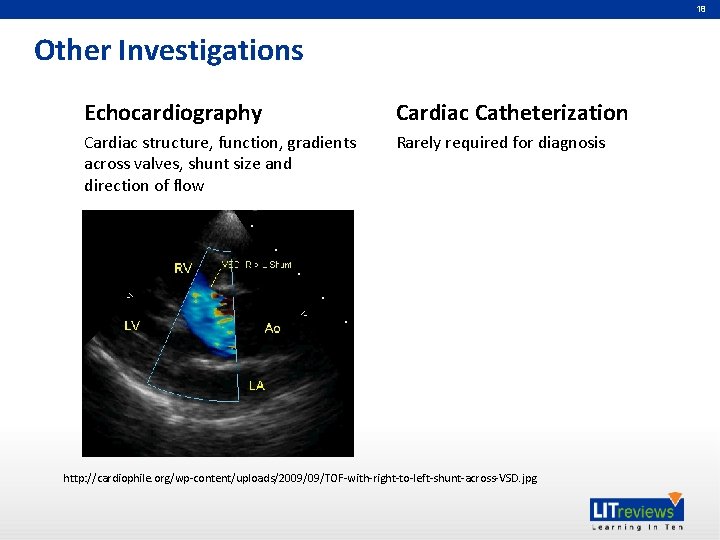 18 Other Investigations Echocardiography Cardiac Catheterization Cardiac structure, function, gradients across valves, shunt size