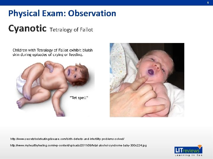 9 Physical Exam: Observation Cyanotic Tetralogy of Fallot http: //www. secretstodefeatingdisease. com/birth-defects-and-infertility-problems-solved/ http: //www.