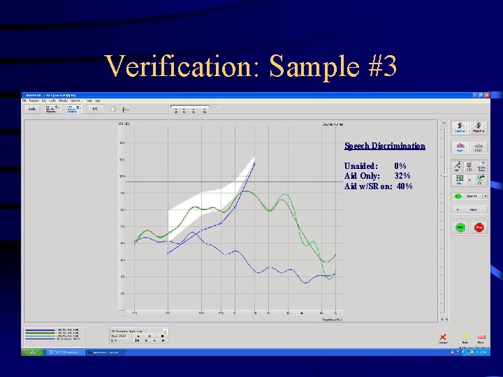 Verification: Sample #3 Speech Discrimination Unaided: 0% Aid Only: 32% Aid w/SR on: 40%