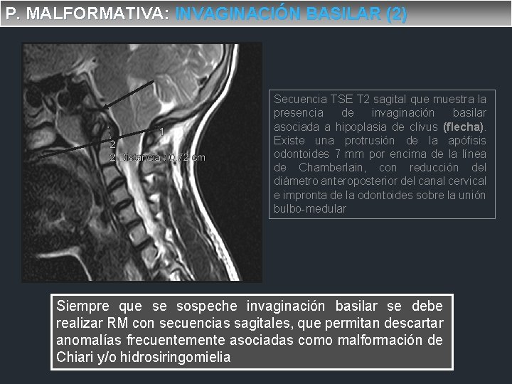P. MALFORMATIVA: INVAGINACIÓN BASILAR (2) Secuencia TSE T 2 sagital que muestra la presencia