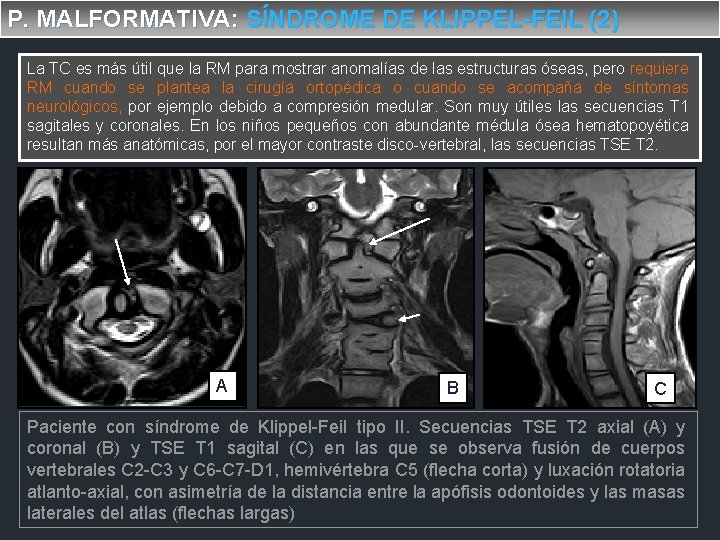 P. MALFORMATIVA: SÍNDROME DE KLIPPEL-FEIL (2) La TC es más útil que la RM