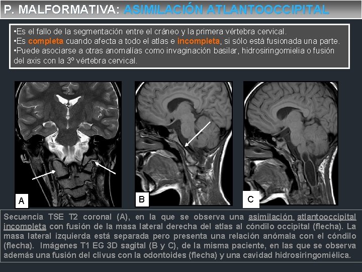 P. MALFORMATIVA: ASIMILACIÓN ATLANTOOCCIPITAL • Es el fallo de la segmentación entre el cráneo