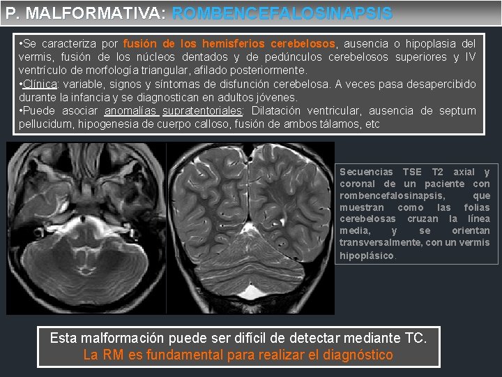 P. MALFORMATIVA: ROMBENCEFALOSINAPSIS • Se caracteriza por fusión de los hemisferios cerebelosos, ausencia o