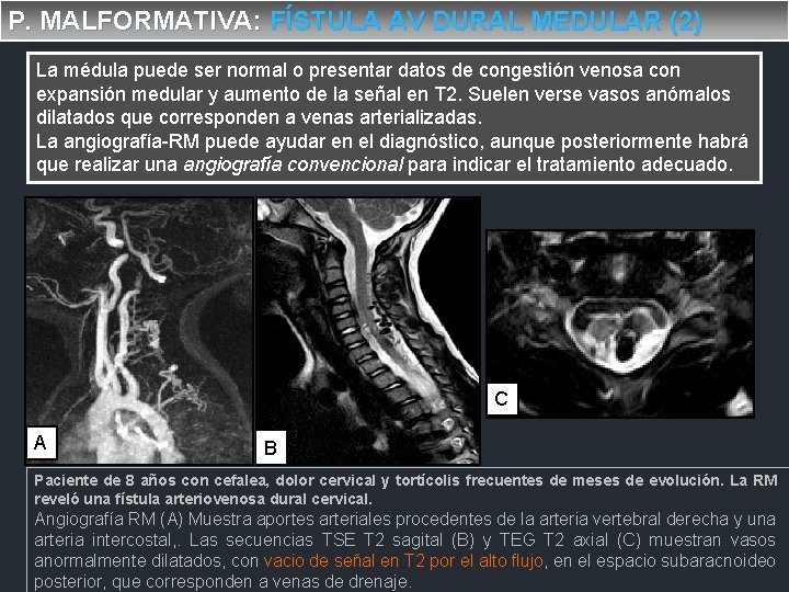 P. MALFORMATIVA: FÍSTULA AV DURAL MEDULAR (2) La médula puede ser normal o presentar