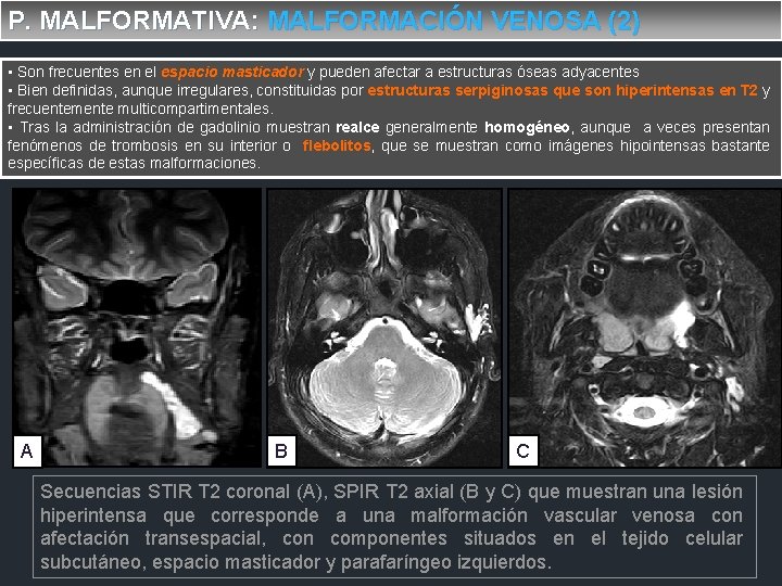 P. MALFORMATIVA: MALFORMACIÓN VENOSA (2) • Son frecuentes en el espacio masticador y pueden