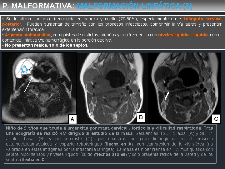 P. MALFORMATIVA: MALFORMACIÓN LINFÁTICA (3) • Se localizan con gran frecuencia en cabeza y