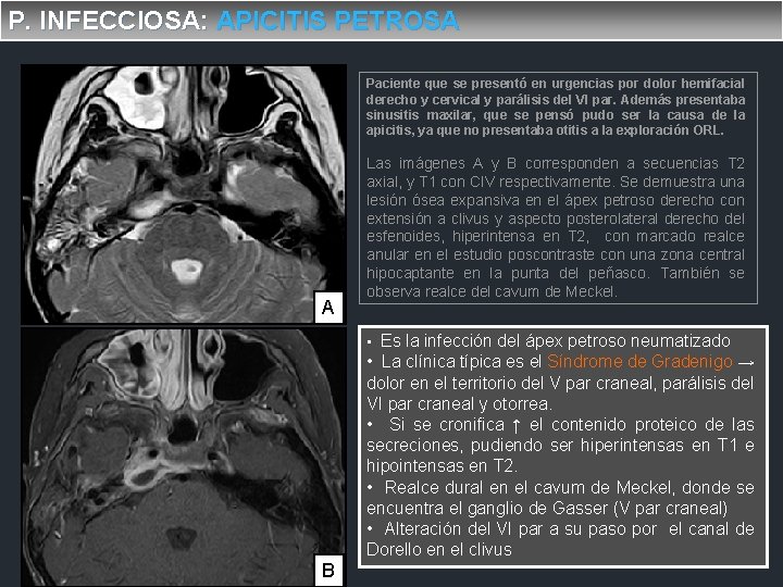 P. INFECCIOSA: APICITIS PETROSA Paciente que se presentó en urgencias por dolor hemifacial derecho