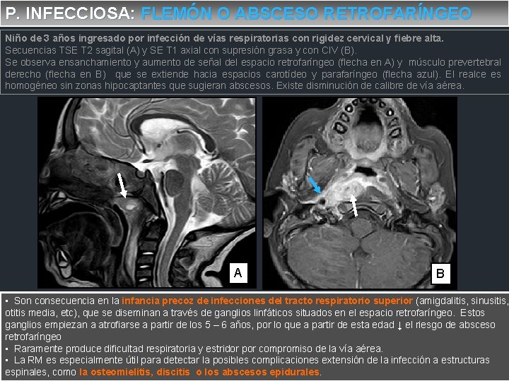 P. INFECCIOSA: FLEMÓN O ABSCESO RETROFARÍNGEO Niño de 3 años ingresado por infección de