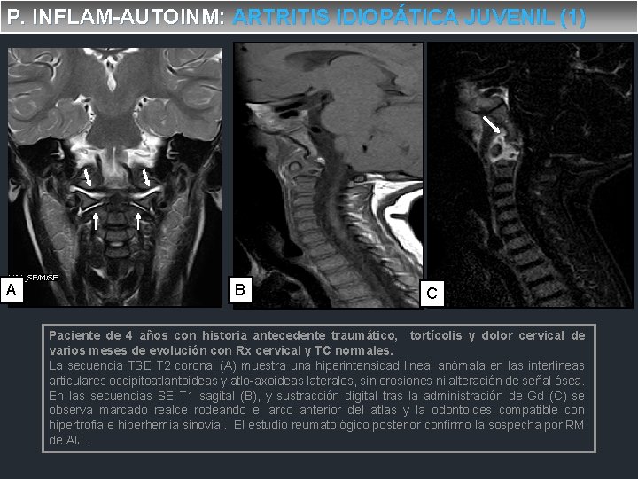 P. INFLAM-AUTOINM: ARTRITIS IDIOPÁTICA JUVENIL (1) A A B C Paciente de 4 años