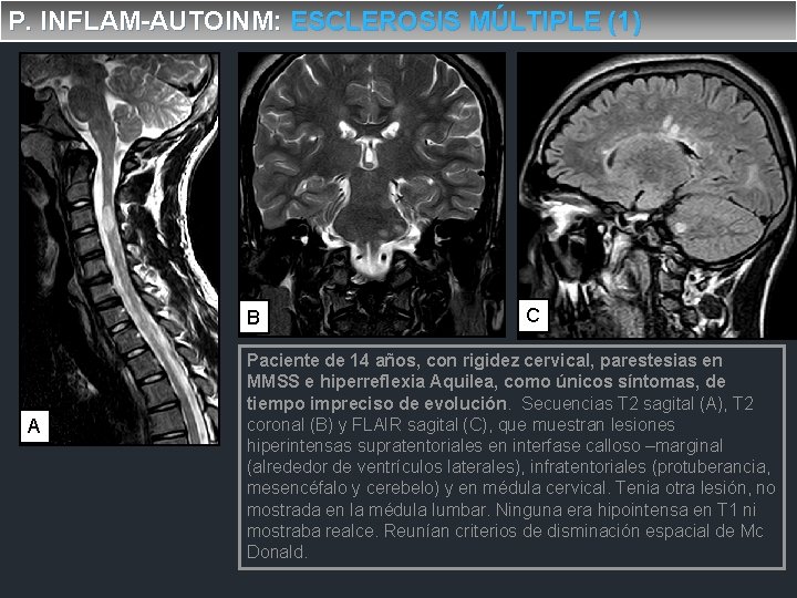 P. INFLAM-AUTOINM: ESCLEROSIS MÚLTIPLE (1) B A C Paciente de 14 años, con rigidez