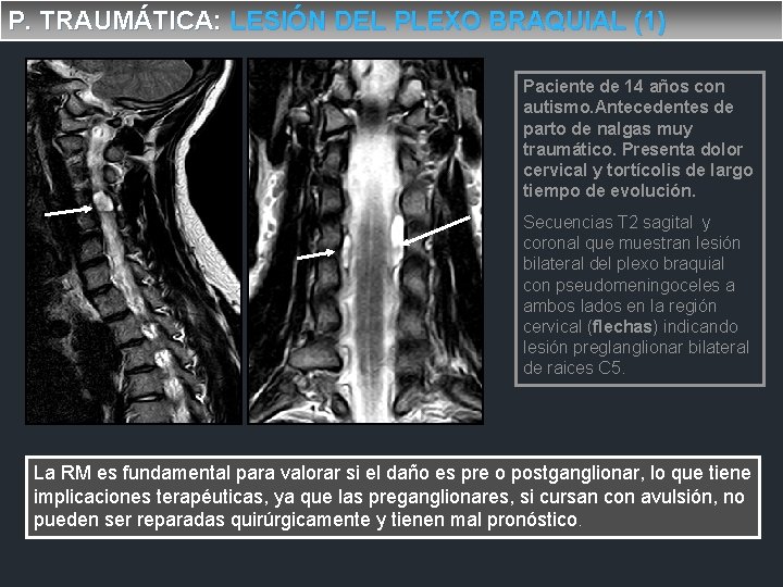 P. TRAUMÁTICA: LESIÓN DEL PLEXO BRAQUIAL (1) Paciente de 14 años con autismo. Antecedentes