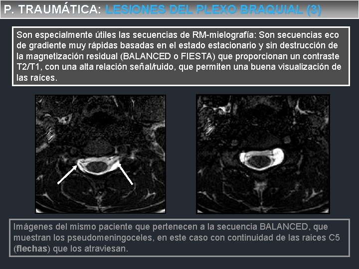 P. TRAUMÁTICA: LESIONES DEL PLEXO BRAQUIAL (3) Son especialmente útiles las secuencias de RM-mielografía: