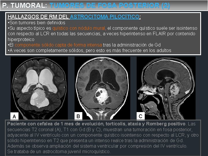 P. TUMORAL: TUMORES DE FOSA POSTERIOR (2) HALLAZGOS DE RM DEL ASTROCITOMA PILOCÍTICO: •