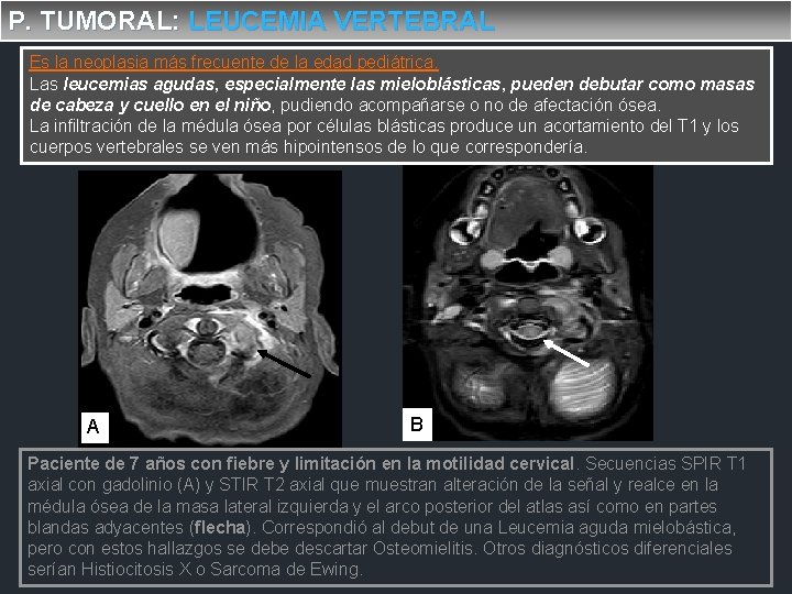 P. TUMORAL: LEUCEMIA VERTEBRAL Es la neoplasia más frecuente de la edad pediátrica. Las