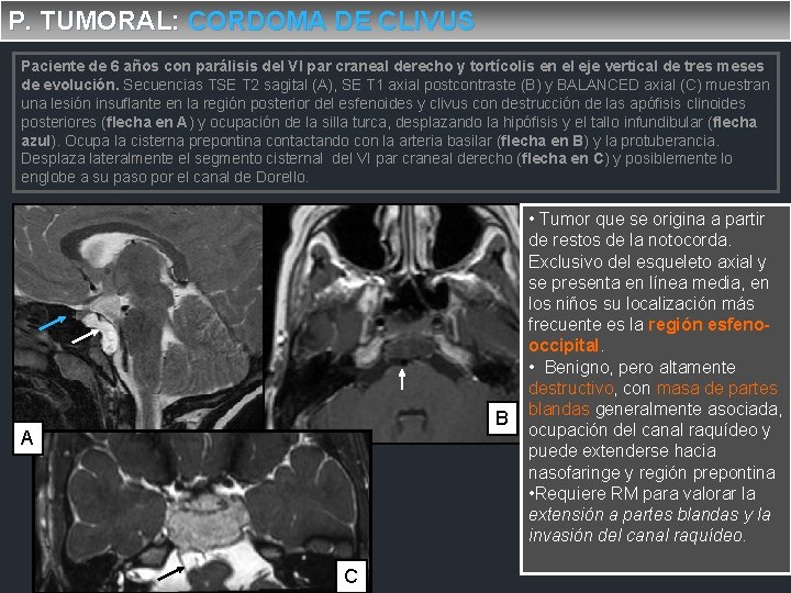 P. TUMORAL: CORDOMA DE CLIVUS Paciente de 6 años con parálisis del VI par