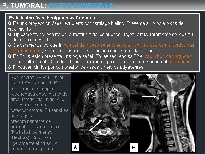 P. TUMORAL: OSTEOCONDROMA Es la lesión ósea benigna más frecuente Es una proyección ósea