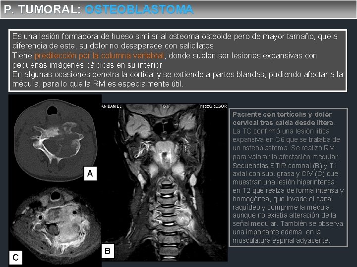 P. TUMORAL: OSTEOBLASTOMA Es una lesión formadora de hueso similar al osteoma osteoide pero