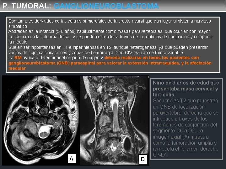 P. TUMORAL: GANGLIONEUROBLASTOMA Son tumores derivados de las células primordiales de la cresta neural