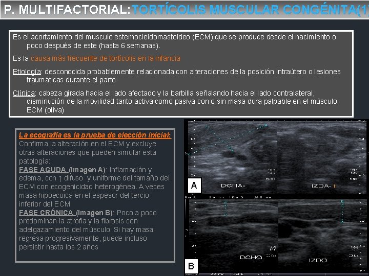 P. MULTIFACTORIAL: TORTÍCOLIS MUSCULAR CONGÉNITA(1) Es el acortamiento del músculo esternocleidomastoideo (ECM) que se