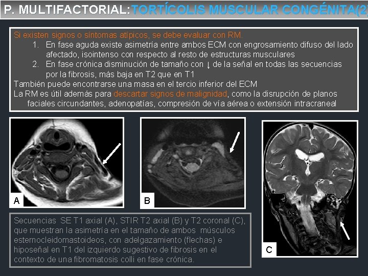 P. MULTIFACTORIAL: TORTÍCOLIS MUSCULAR CONGÉNITA(2) Si existen signos o síntomas atípicos, se debe evaluar