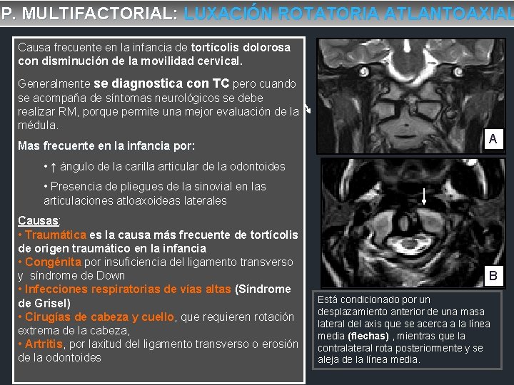 P. MULTIFACTORIAL: LUXACIÓN ROTATORIA ATLANTOAXIAL Causa frecuente en la infancia de tortícolis dolorosa con