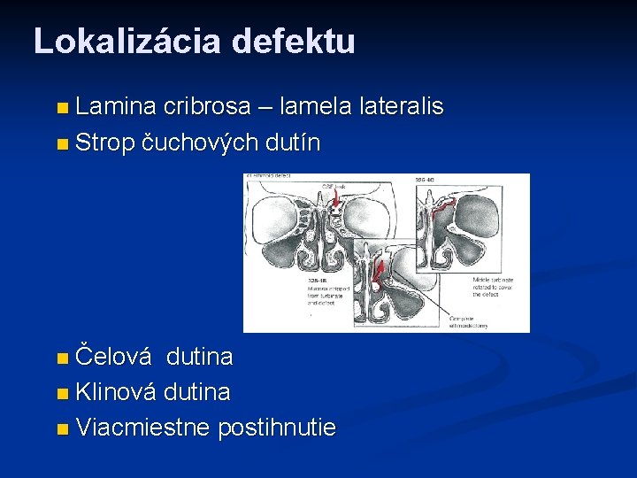 Lokalizácia defektu Lamina cribrosa – lamela lateralis n Strop čuchových dutín n Čelová dutina