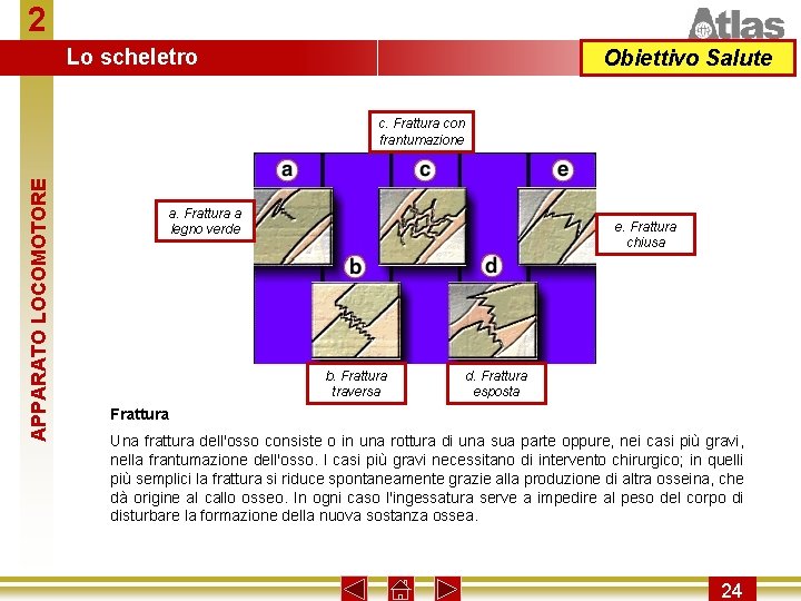 2 Lo scheletro Obiettivo Salute APPARATO LOCOMOTORE c. Frattura con frantumazione a. Frattura a