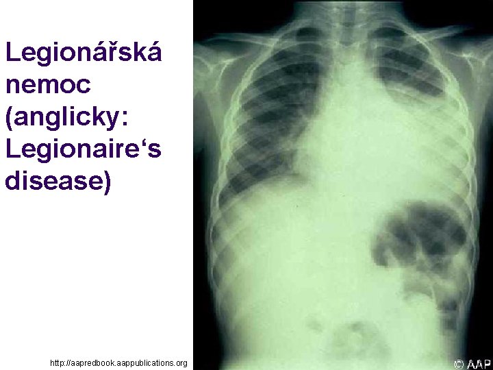 Legionářská nemoc (anglicky: Legionaire‘s disease) http: //aapredbook. aappublications. org 