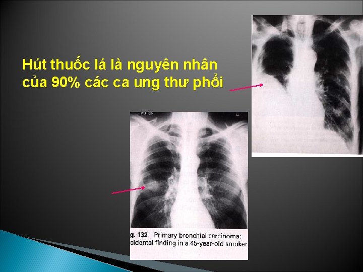 Hút thuốc lá là nguyên nhân của 90% các ca ung thư phổi 